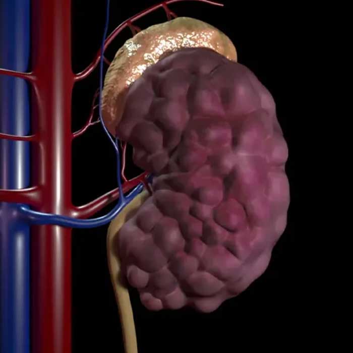 Polycystic-Kidney-Disease